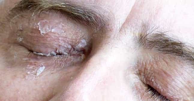 This man glued his eye shut after mistaking glue for eye drops This man glued his eye shut after mistaking glue for eye drops