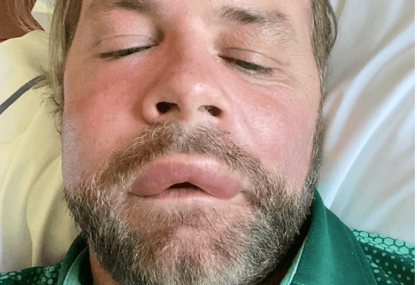Brian McFadden alarms fans after sharing video showing his horrific reaction to ‘bee sting’
