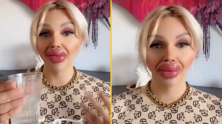 Woman who’s undergone huge lip injections says it’s difficult to eat and drink