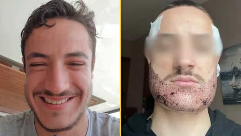 Student takes own life after Turkey beard transplant by ‘estate agent posing as a surgeon’