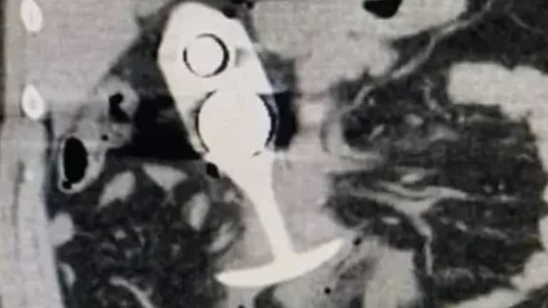 Woman left with horrific injuries after wearing sex toy to MRI scan Woman left with horrific injuries after wearing sex toy to MRI scan