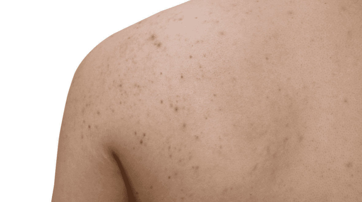 This is the perfect product to use if you suffer from stubborn body acne