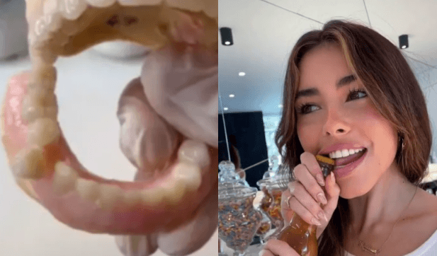 Dentist shows dangers of using your teeth to open beer bottles Dentist shows dangers of using your teeth to open beer bottles