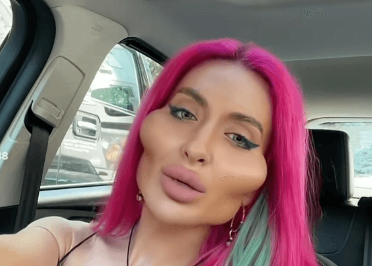 Model with ‘world’s biggest cheeks’ shows what she looked like at 16 – before transformation
