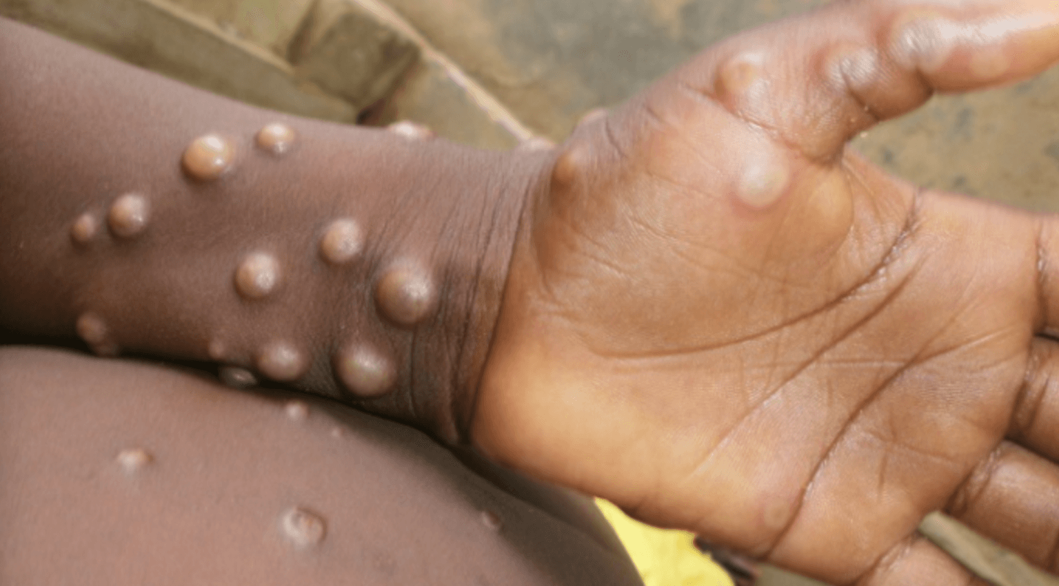 Monkeypox: Two more people diagnosed in the UK