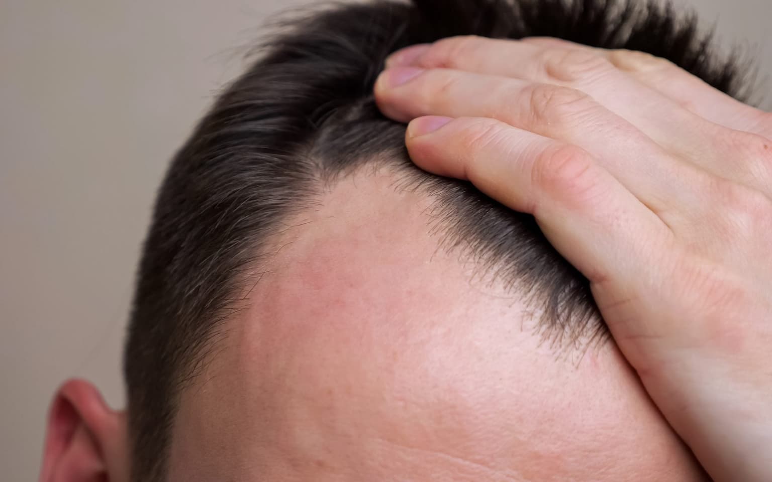 Follically challenged, rejoice – scientists have discovered a potential cure for baldness