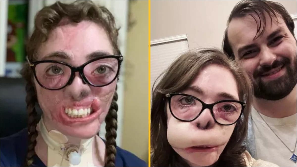 Dogsitter reveals results of reconstructive surgery after most of her face was torn off in dog attack