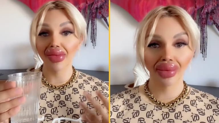 Woman who’s undergone huge lip injections says it’s difficult to eat and drink Woman who’s undergone huge lip injections says it’s difficult to eat and drink