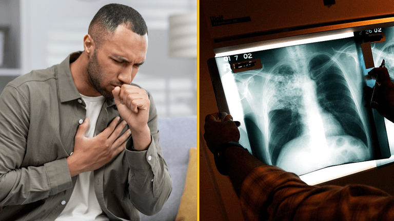 Warnings issued over rise of TB cases in the UK Warnings issued over rise of TB cases in the UK