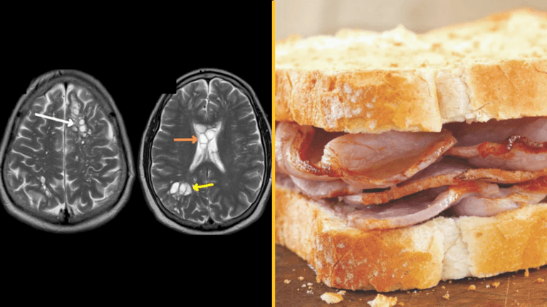 Man discovers headaches caused by parasite in his brain from not cooking crispy bacon Man discovers headaches caused by parasite in his brain from not cooking crispy bacon