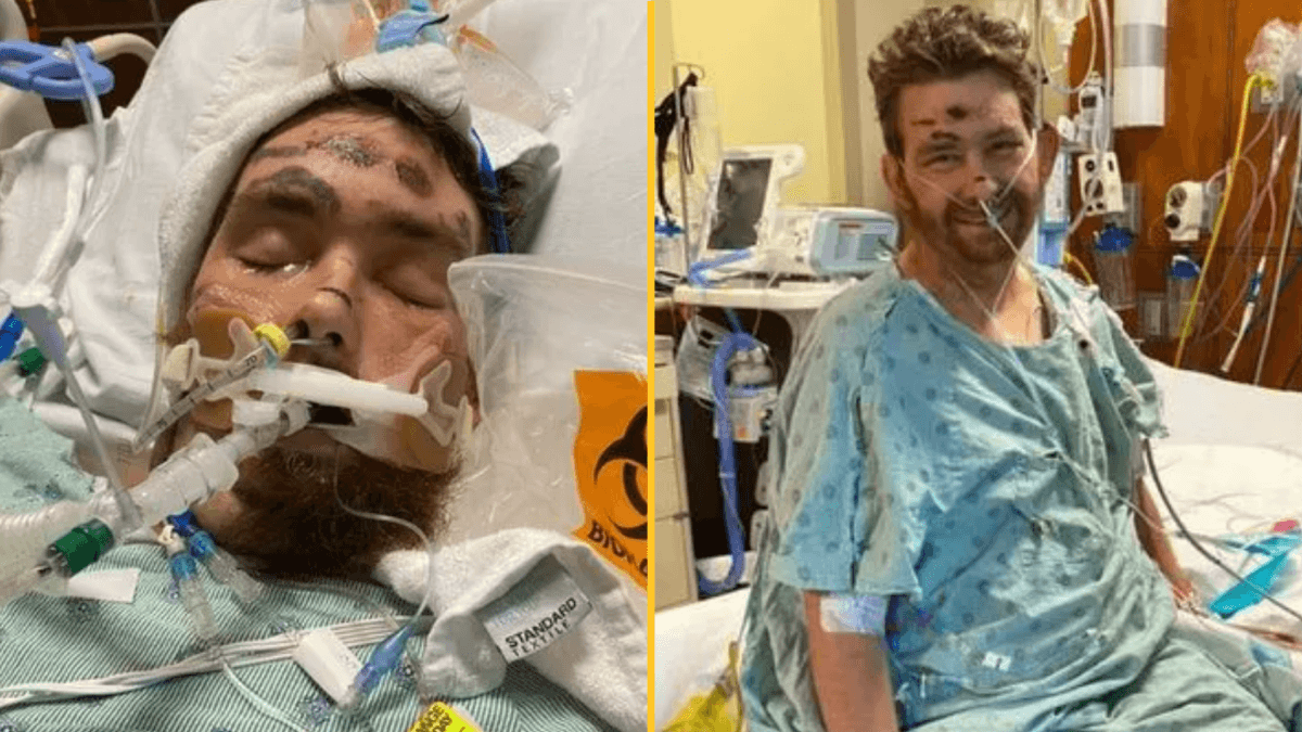 Ingrown hair left man in coma with 4% chance of survival
