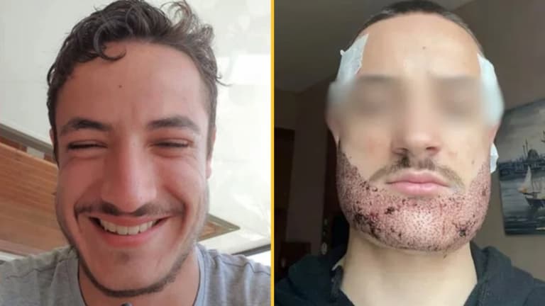 Student takes own life after Turkey beard transplant by ‘estate agent posing as a surgeon’ Student takes own life after Turkey beard transplant by ‘estate agent posing as a surgeon’