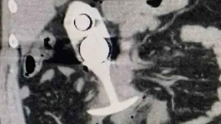 Woman left with horrific injuries after wearing sex toy to MRI scan Woman left with horrific injuries after wearing sex toy to MRI scan