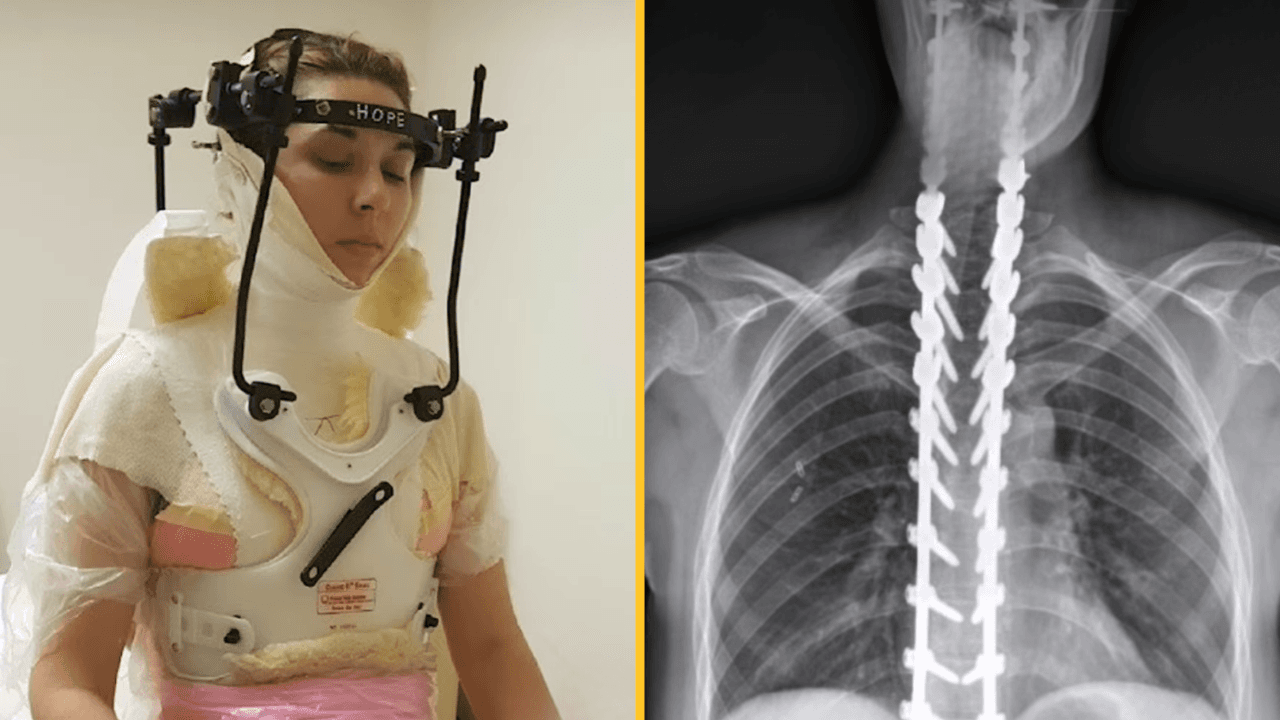 Woman has skull reattached after being ‘decapitated’ in freak football injury