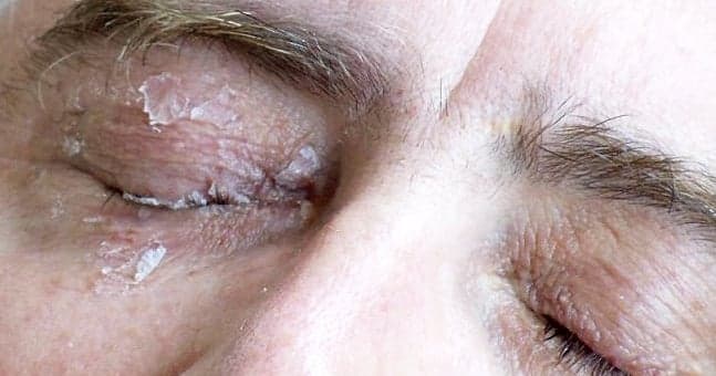 This man glued his eye shut after mistaking glue for eye drops This man glued his eye shut after mistaking glue for eye drops