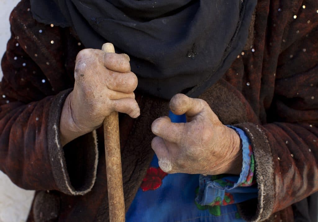 The bacteria that causes leprosy is mutating into something even more dangerous