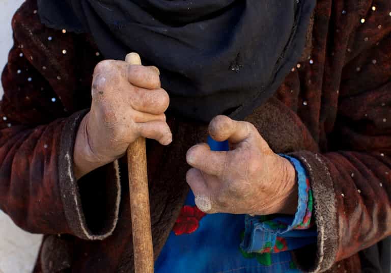 The bacteria that causes leprosy is mutating into something even more dangerous The bacteria that causes leprosy is mutating into something even more dangerous