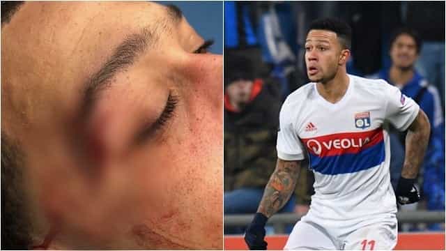 Memphis Depay shows off nasty cut picked up in dramatic win Memphis Depay shows off nasty cut picked up in dramatic win