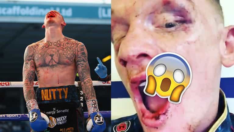 GRAPHIC: Mason Cartwright reveals the extent of horrific mouth injury suffered during Darren Tetley fight GRAPHIC: Mason Cartwright reveals the extent of horrific mouth injury suffered during Darren Tetley fight