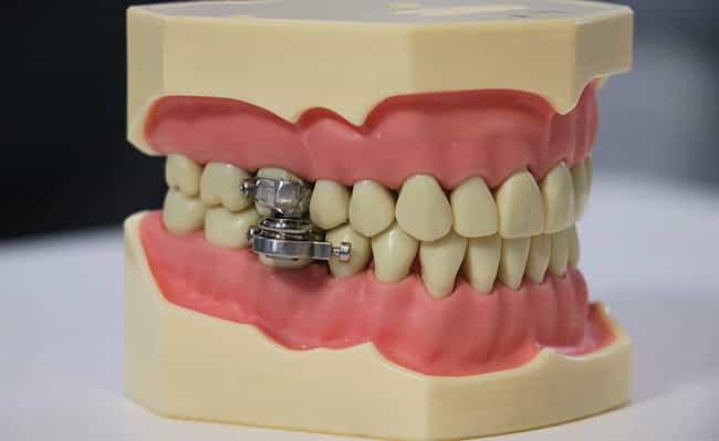 New weight loss device that clamps jaw shut trialled in New Zealand New weight loss device that clamps jaw shut trialled in New Zealand