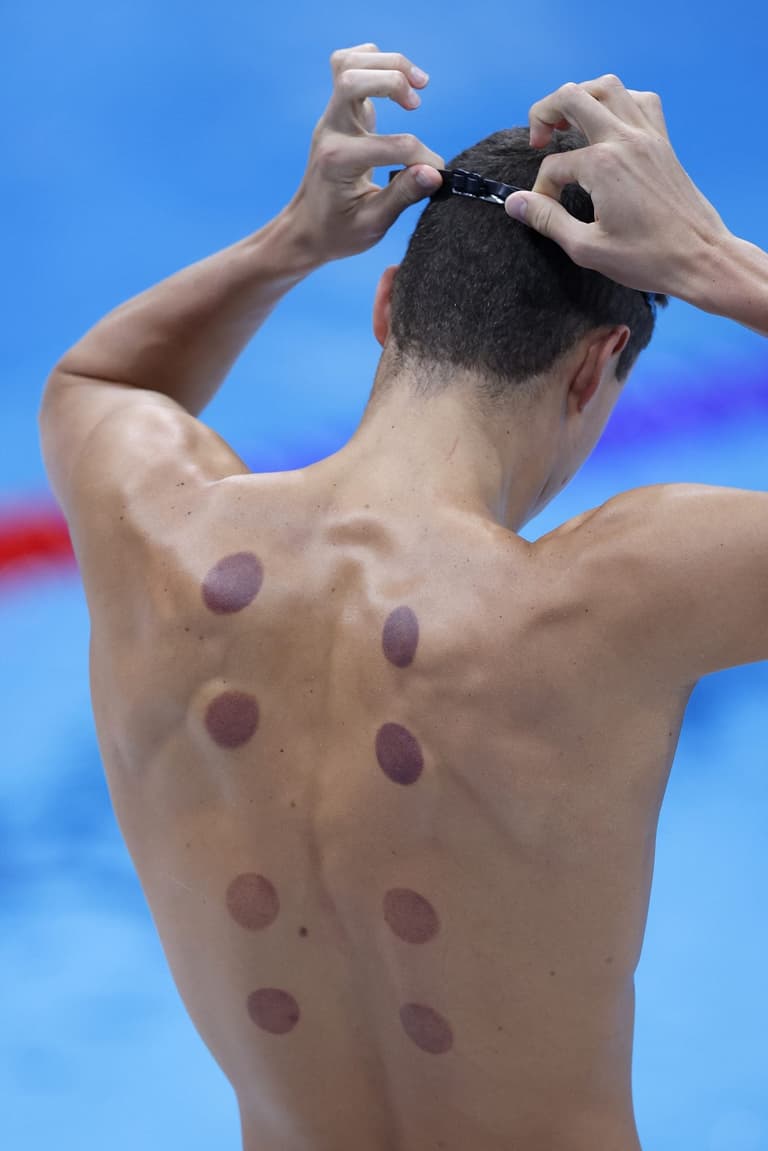 What are the dark circles on swimmers’ backs at Paris Olympics What are the dark circles on swimmers’ backs at Paris Olympics