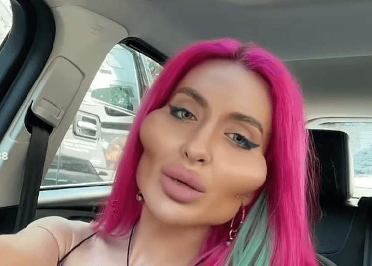 Model with ‘world’s biggest cheeks’ shows what she looked like at 16 – before transformation Model with ‘world’s biggest cheeks’ shows what she looked like at 16 – before transformation
