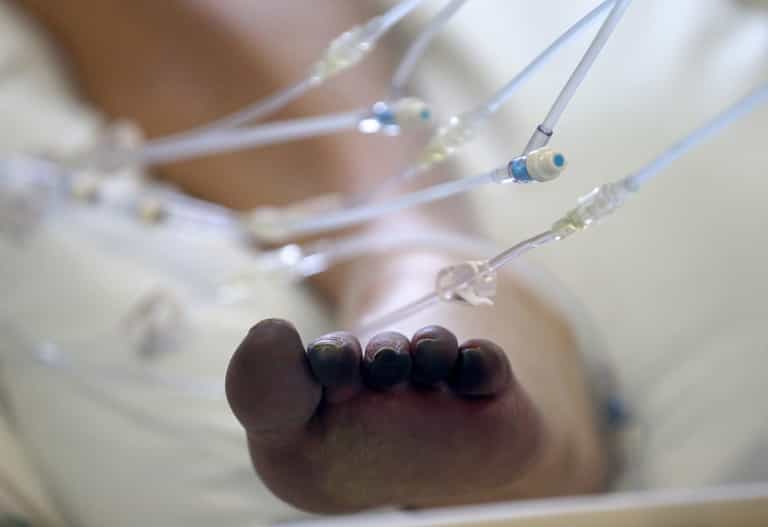 Study reveals why some people get ‘Covid toe’ Study reveals why some people get ‘Covid toe’