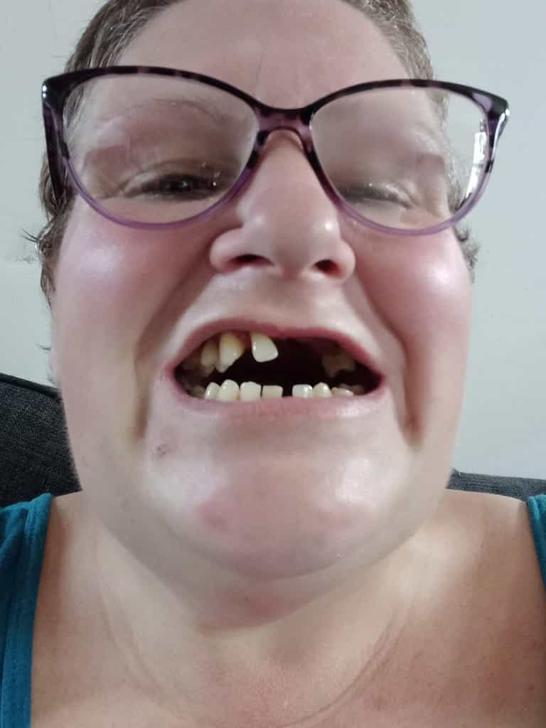Desperate mum pulls out 11 of her own teeth because she couldn’t find a dentist Desperate mum pulls out 11 of her own teeth because she couldn’t find a dentist