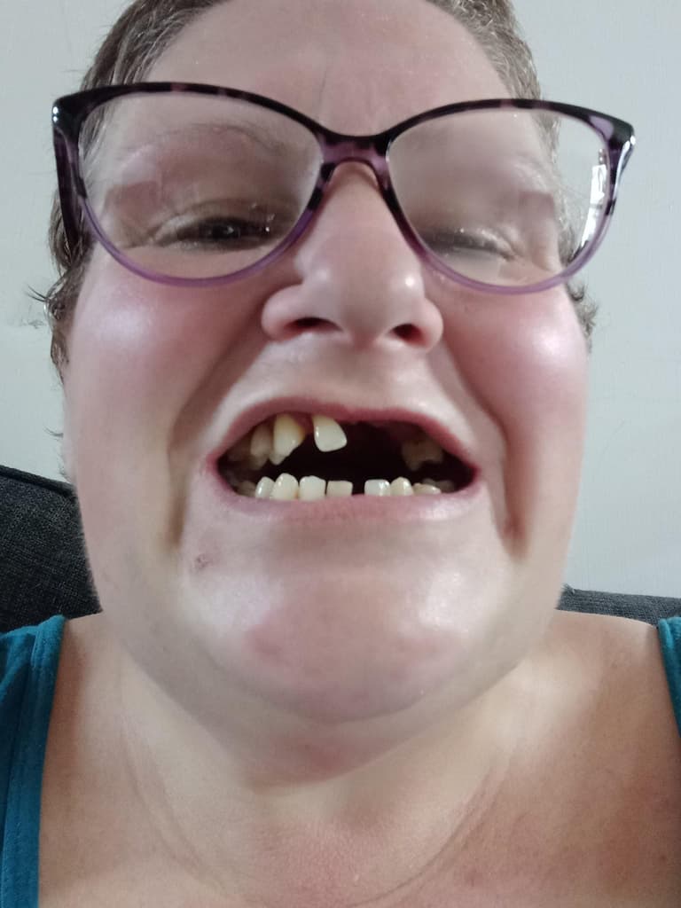Desperate mum pulls out 11 of her own teeth because she couldn’t find a dentist Desperate mum pulls out 11 of her own teeth because she couldn’t find a dentist