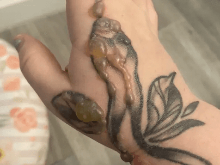 Woman horrified after warts grew on tattoo and had to be burned off