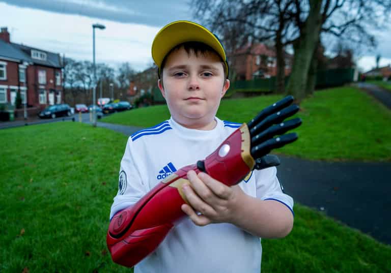 Boy fitted with £10,000 bionic ‘Iron Man’ arm Boy fitted with £10,000 bionic ‘Iron Man’ arm