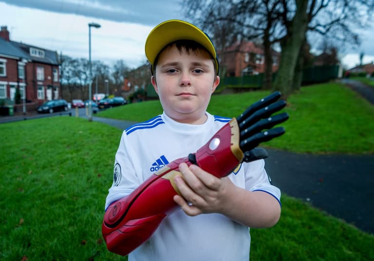 Boy fitted with £10,000 bionic ‘Iron Man’ arm Boy fitted with £10,000 bionic ‘Iron Man’ arm