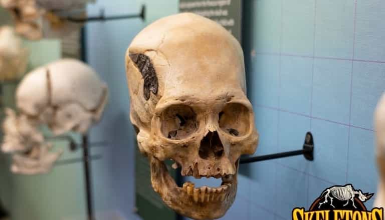 2,000 year old skull held together by metal offers evidence of ancient surgery 2,000 year old skull held together by metal offers evidence of ancient surgery