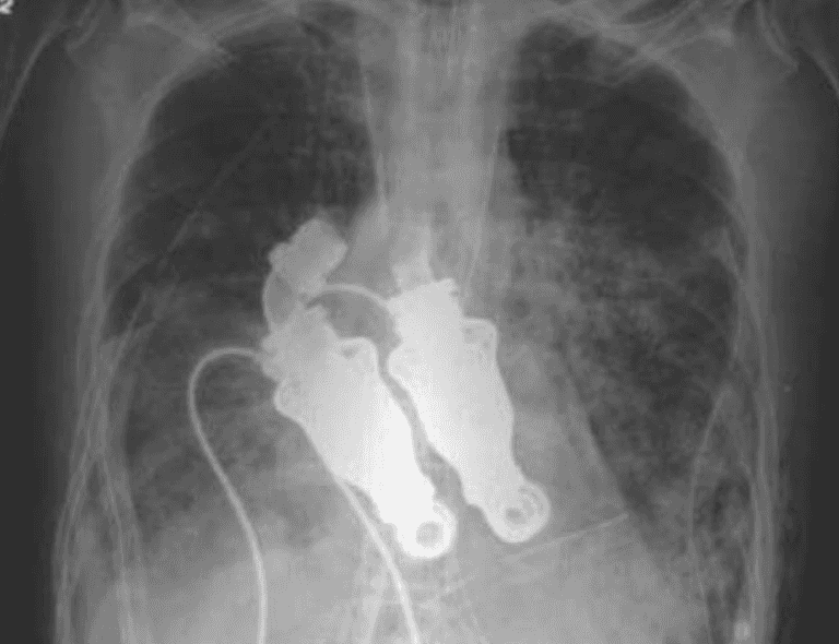 The world’s first heartless human who lived without a pulse The world’s first heartless human who lived without a pulse