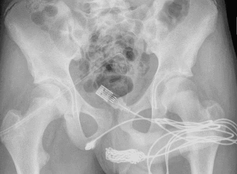 Teen gets USB cable stuck in penis during experiment ‘to work out how big’ it is Teen gets USB cable stuck in penis during experiment ‘to work out how big’ it is