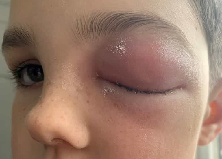 Boy, nine, ‘almost goes blind’ after suffering rare ‘Covid-eye’ side effect Boy, nine, ‘almost goes blind’ after suffering rare ‘Covid-eye’ side effect