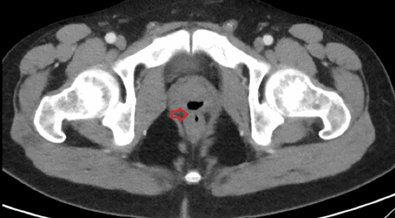 Medical complication causes man to ejaculate out of anus for two years Medical complication causes man to ejaculate out of anus for two years