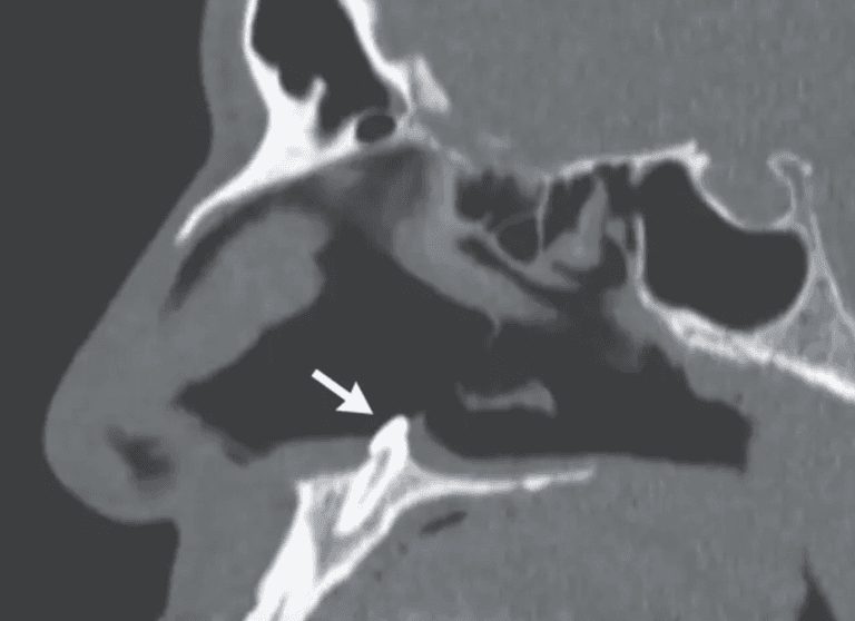Man who struggled to breathe finds tooth growing in nose Man who struggled to breathe finds tooth growing in nose