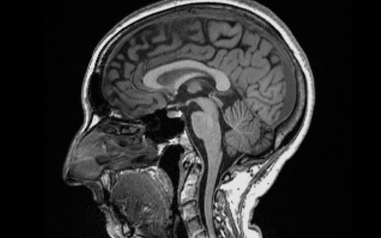 Covid brain can cause brain to shrink, new study finds Covid brain can cause brain to shrink, new study finds
