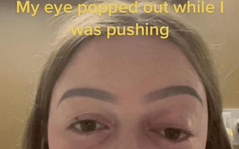 Woman pushed so hard while giving birth that her eye ‘popped out’ Woman pushed so hard while giving birth that her eye ‘popped out’