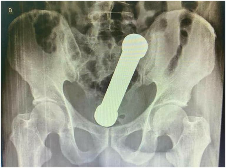 Man gets 2kg dumbbell stuck in his bum – doctors forced to pull 20cm weight out by hand Man gets 2kg dumbbell stuck in his bum – doctors forced to pull 20cm weight out by hand