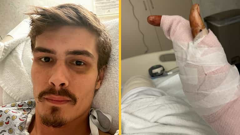 Man miraculously survives being hit by train but is left with half a hand Man miraculously survives being hit by train but is left with half a hand