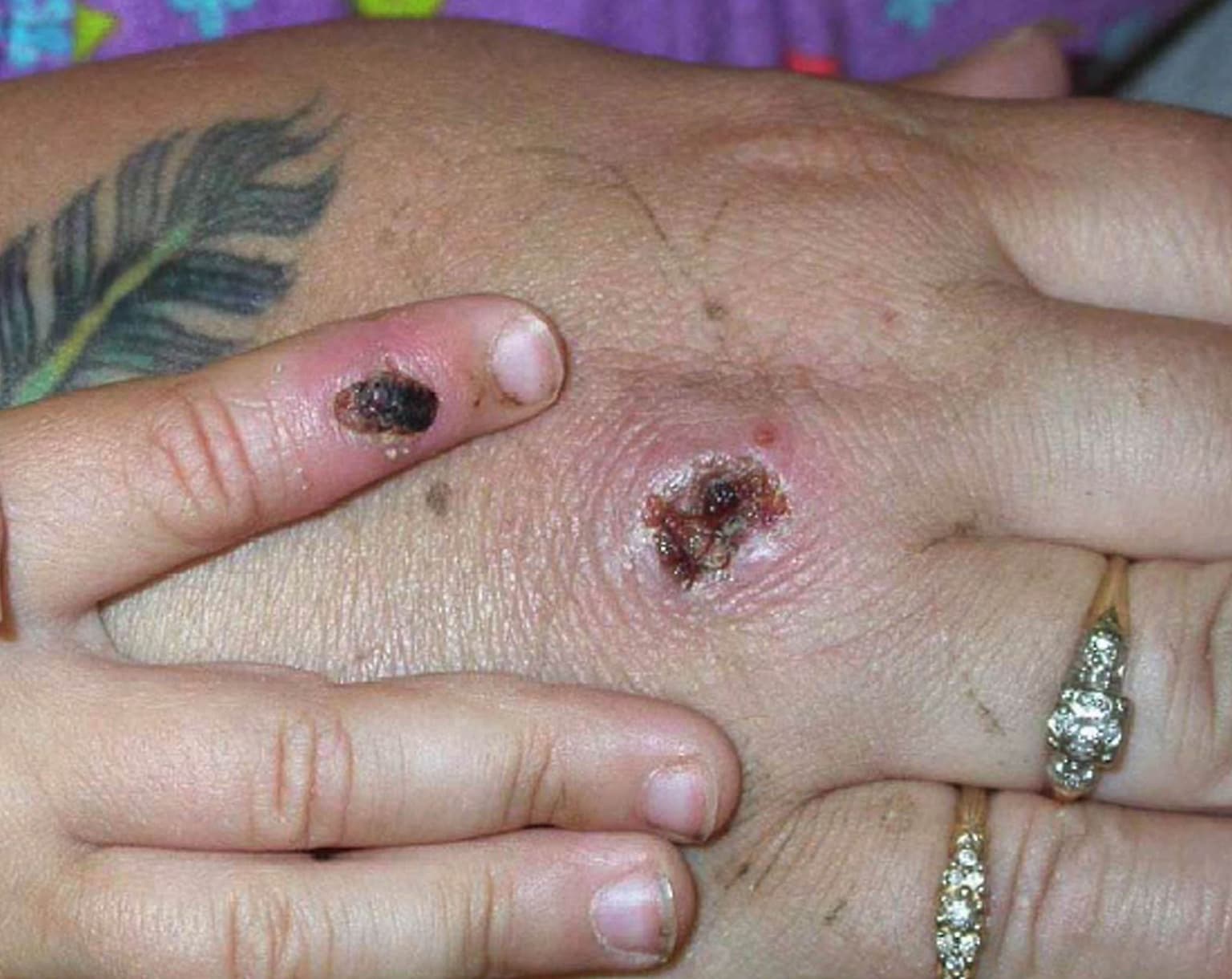 Monkeypox case confirmed in the UK as authorities issue urgent health warning