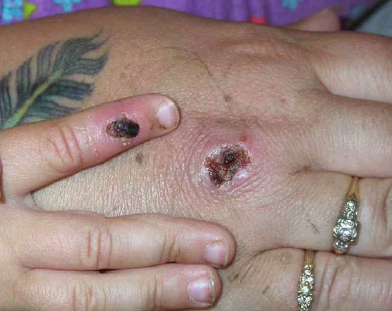 Monkeypox case confirmed in the UK as authorities issue urgent health warning Monkeypox case confirmed in the UK as authorities issue urgent health warning