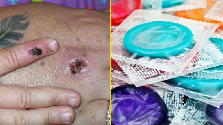 Doctors concerned about impact of Monkeypox on sexual health Doctors concerned about impact of Monkeypox on sexual health