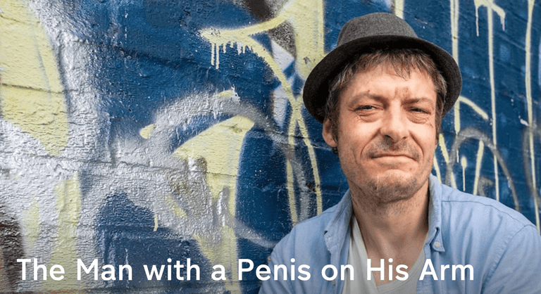 Dad reveals all about the moment his penis fell off – and how he replaced it with a bigger one Dad reveals all about the moment his penis fell off – and how he replaced it with a bigger one