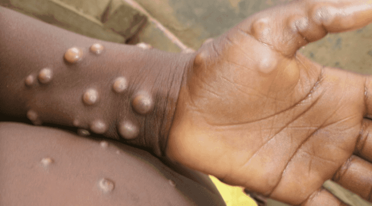 Monkeypox: Two more people diagnosed in the UK Monkeypox: Two more people diagnosed in the UK