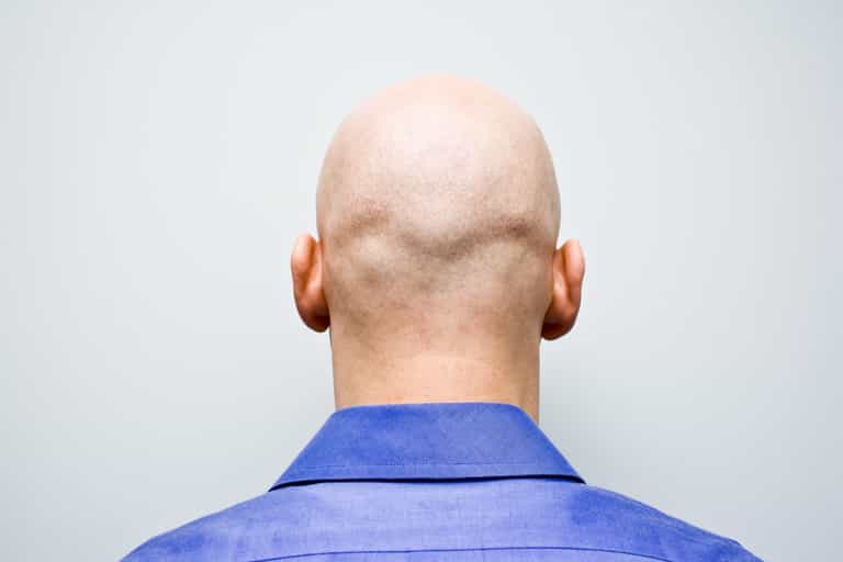 Calling men bald is now sex harassment, judge rules Calling men bald is now sex harassment, judge rules