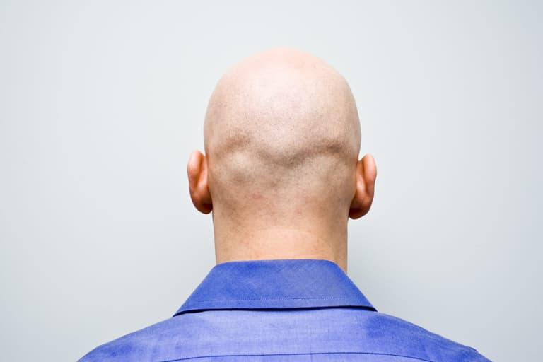 Calling men bald is now sex harassment, judge rules Calling men bald is now sex harassment, judge rules
