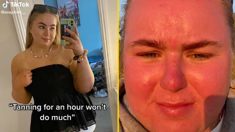 Woman’s face ‘doubles in size’ after spending just an hour in the sun Woman’s face ‘doubles in size’ after spending just an hour in the sun